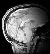Jered's brain, sagittal slice 31